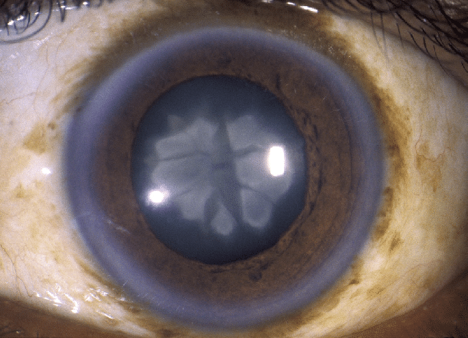 Ядерная катаракта глаз